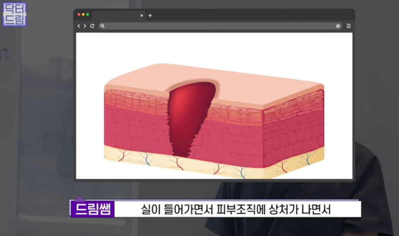 실리프팅 가장 효과 좋은 나이/ 실리프팅 몇살부터 하나요? 사진 26