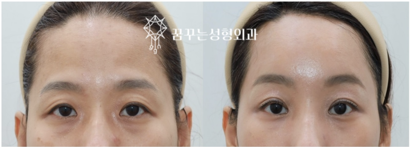 [강남역성형외과]40대 여성의 내시경 이마 거상 후기: 꿈꾸는 성형외과에서 다시 찾은 젊음 사진 4