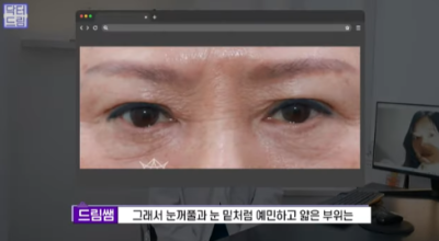 눈밑지방 없애러 왔는데 지방이식을 하라구요? 사진 23