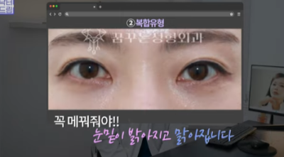 눈밑지방 없애러 왔는데 지방이식을 하라구요? 사진 12