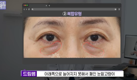 눈밑지방 없애러 왔는데 지방이식을 하라구요? 사진 9