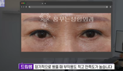 눈밑지방 없애러 왔는데 지방이식을 하라구요? 사진 24
