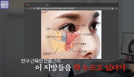 눈밑지방 없애러 왔는데 지방이식을 하라구요? 사진 4