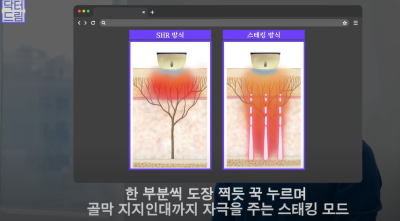 안아프고 하자마자 이뻐지는 티타늄레이저, 나만 아픈 이유? 작용원리 알아보기 사진 20