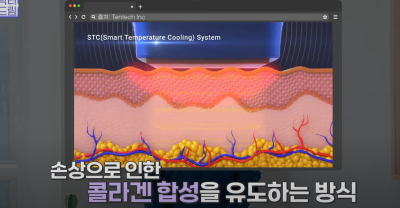 안아프고 하자마자 이뻐지는 티타늄레이저, 나만 아픈 이유? 작용원리 알아보기 사진 25
