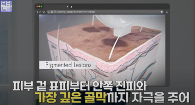 안아프고 하자마자 이뻐지는 티타늄레이저, 나만 아픈 이유? 작용원리 알아보기 사진 8