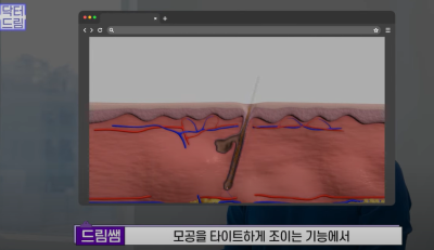 안아프고 하자마자 이뻐지는 티타늄레이저, 나만 아픈 이유? 작용원리 알아보기 사진 6