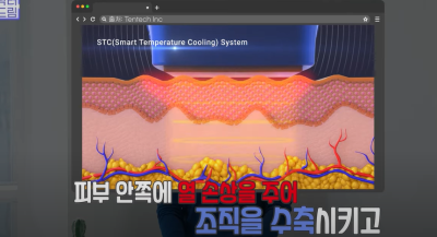 안아프고 하자마자 이뻐지는 티타늄레이저, 나만 아픈 이유? 작용원리 알아보기 사진 24