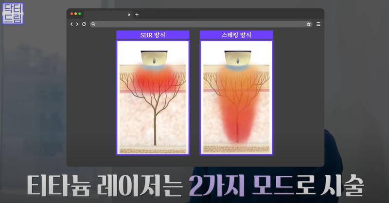 안아프고 하자마자 이뻐지는 티타늄레이저, 나만 아픈 이유? 작용원리 알아보기 사진 18