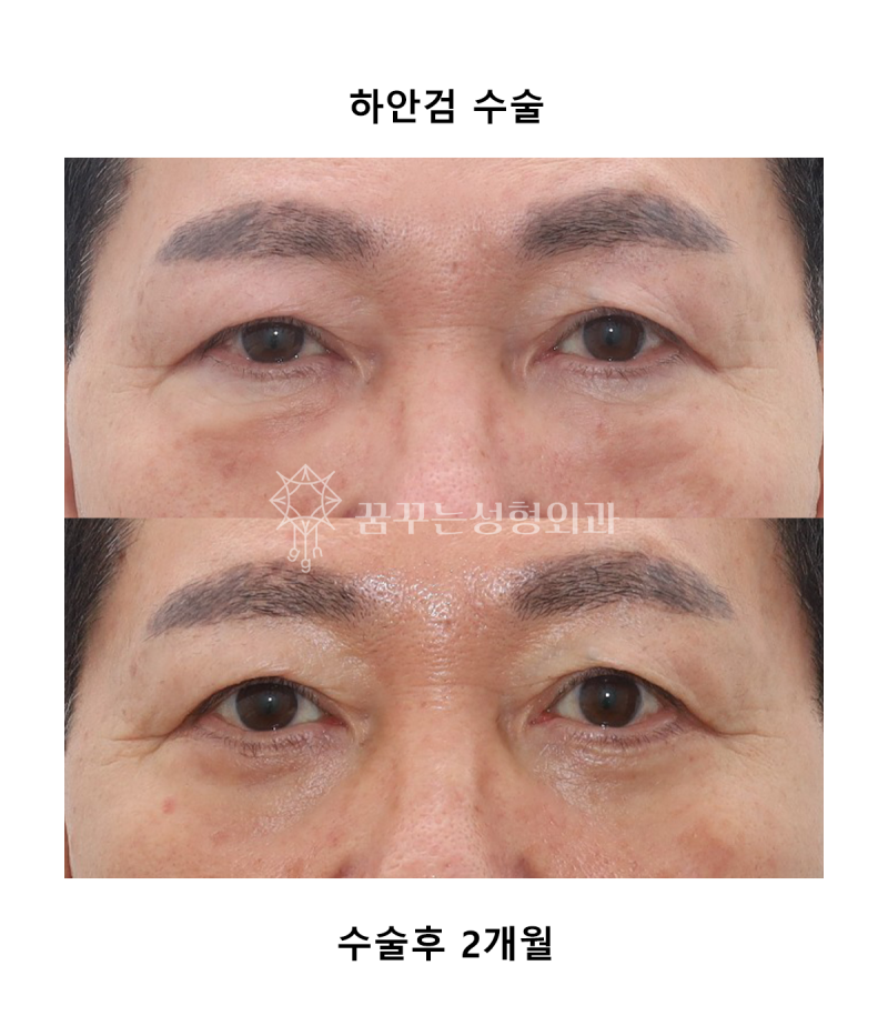 [강남역성형외과] 중년 남성을 위한 하안검 수술: 피로한 눈매에서 젊은 눈매로 변신 사진 2