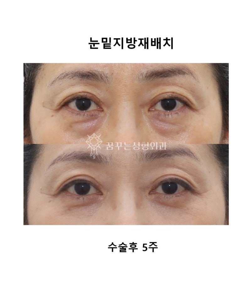 눈 밑 고랑이 꺼져서 다크서클이 심해 보인다면? 눈밑 지방 재배치 수술 추천! 사진 7