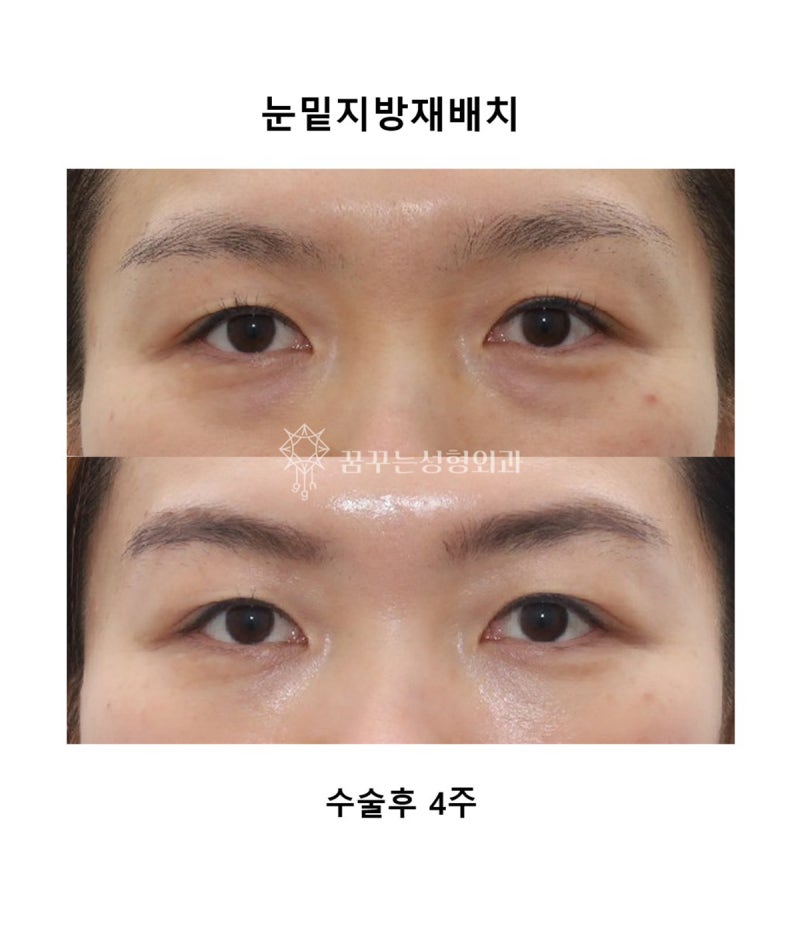 눈 밑 고랑이 꺼져서 다크서클이 심해 보인다면? 눈밑 지방 재배치 수술 추천! 사진 6