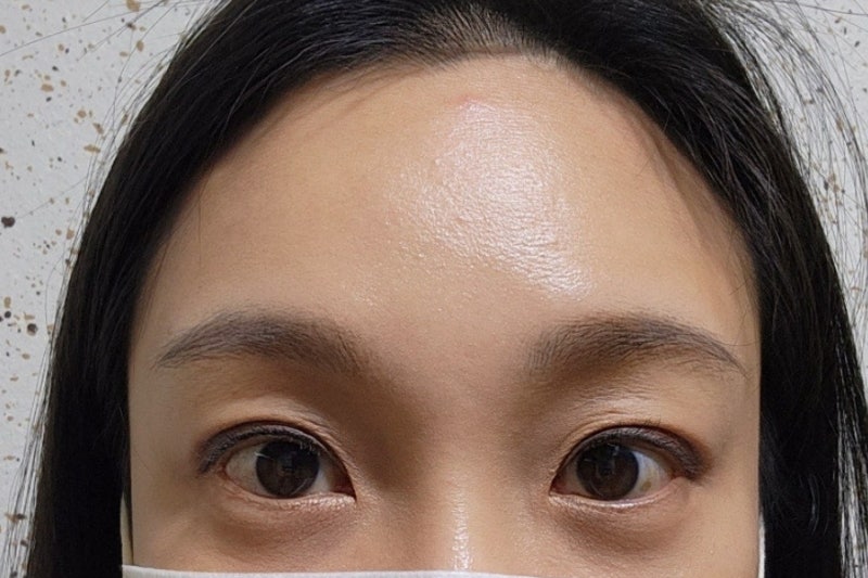 역삼 성형외과, 13년차 전문의가 아내를 직접 수술한 이유 사진 4