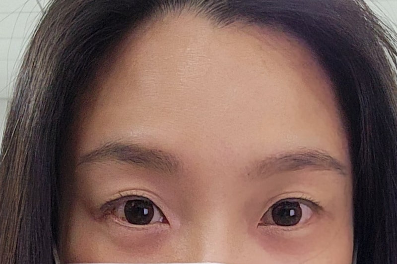 역삼 성형외과, 13년차 전문의가 아내를 직접 수술한 이유 사진 3