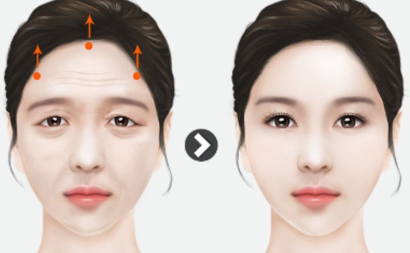 역삼 성형외과, 13년차 전문의가 아내를 직접 수술한 이유 <원장 작성>