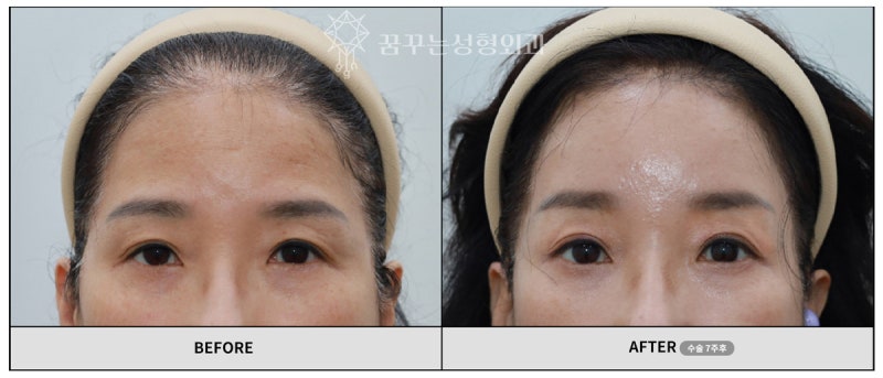 강남이마거상, 실패를 피하는 3가지 체크리스트 – 현직 의사 작성 사진 8
