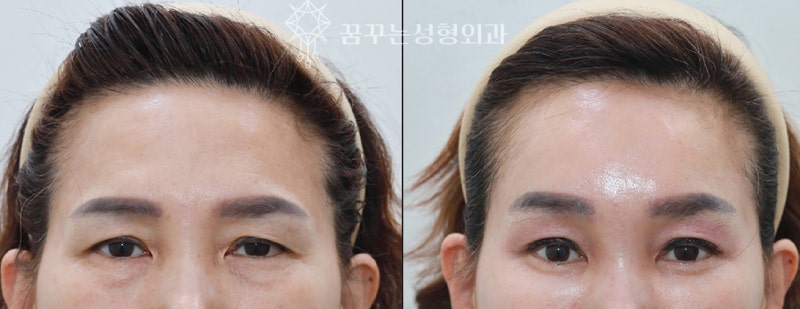강남이마거상, 실패를 피하는 3가지 체크리스트 – 현직 의사 작성 사진 2