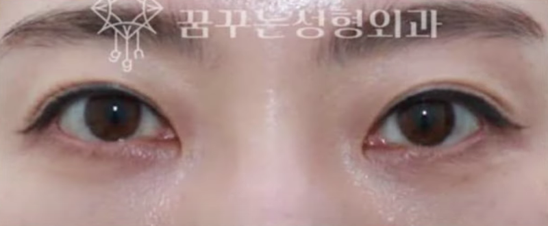 강남역 눈밑지방재배치, '내 눈 밑은 어떤 유형인지' 부터 확인하세요 사진 10