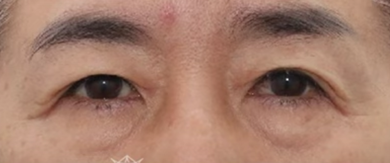강남역 눈밑지방재배치, '내 눈 밑은 어떤 유형인지' 부터 확인하세요 사진 7