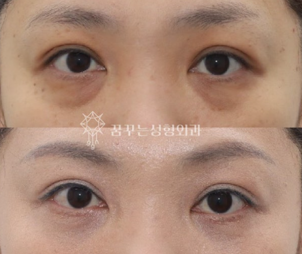 강남역 눈밑지방재배치, '내 눈 밑은 어떤 유형인지' 부터 확인하세요 사진 6