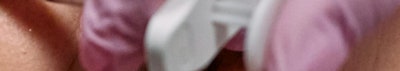신논현 성형외과 팔자주름 실리프팅? 실패하지 않으려면 이것만 보고 가세요. 사진 30