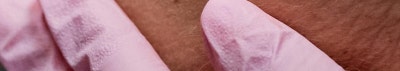 신논현 성형외과 팔자주름 실리프팅? 실패하지 않으려면 이것만 보고 가세요. 사진 35
