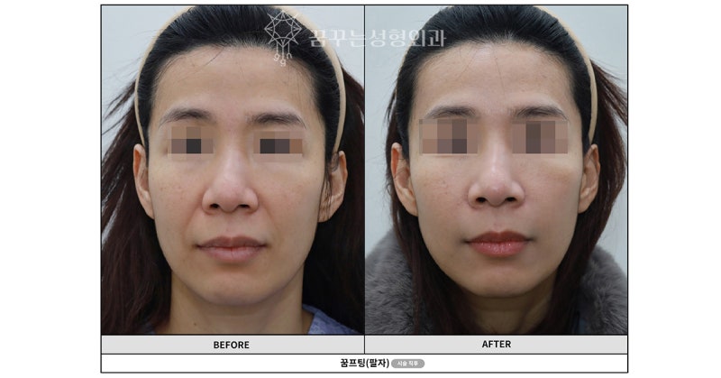 신논현 성형외과 팔자주름 실리프팅? 실패하지 않으려면 이것만 보고 가세요.