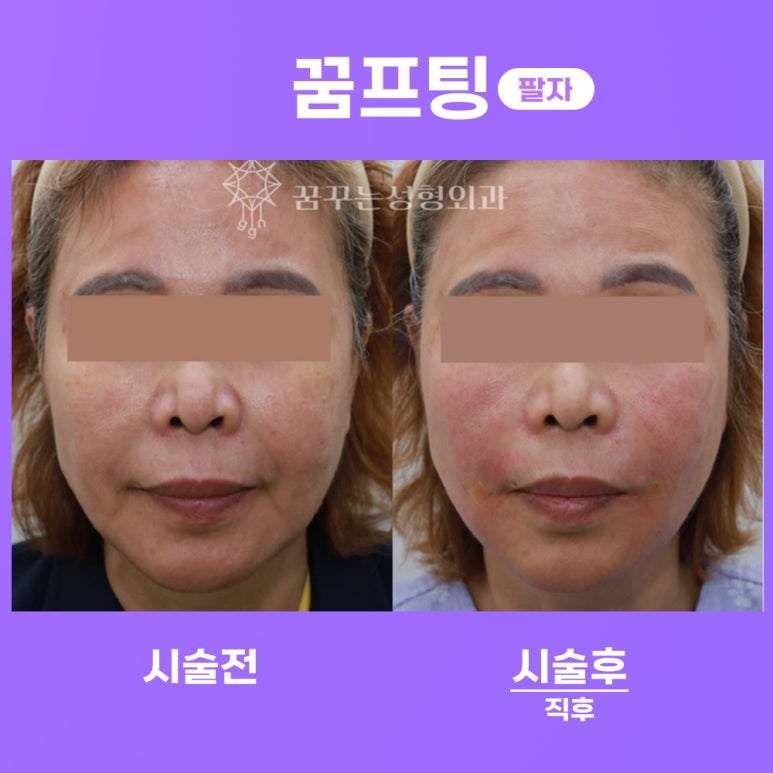강남역 실리프팅 받기 좋은 나이? 저는 이렇게 답변 드립니다. 사진 6