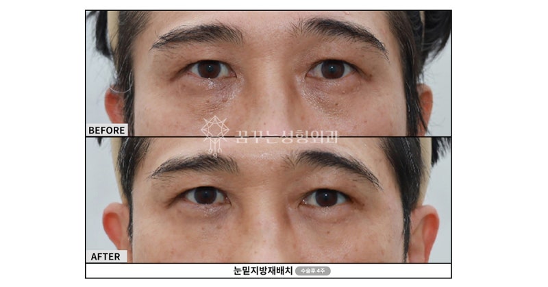 강남역눈밑지방재배치, 부작용을 줄이는 방법은 따로 있다? <대표원장 작성>