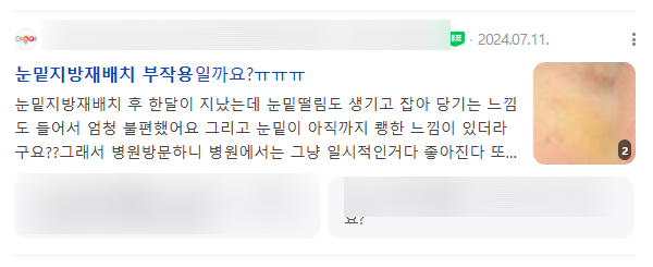 강남역눈밑지방재배치, 부작용을 줄이는 방법은 따로 있다? 사진 3
