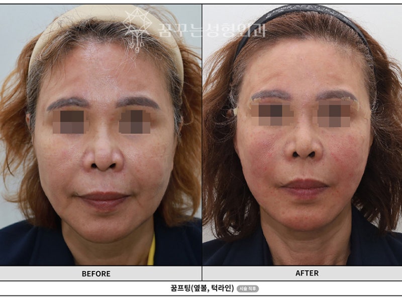 강남안면거상, 먼저 권유드리지 않는 이유? 솔직히 밝힙니다. 사진 6