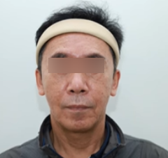 강남안면거상, 먼저 권유드리지 않는 이유? 솔직히 밝힙니다. 사진 3