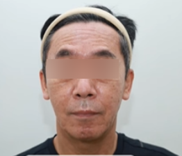 강남안면거상, 먼저 권유드리지 않는 이유? 솔직히 밝힙니다. 사진 2