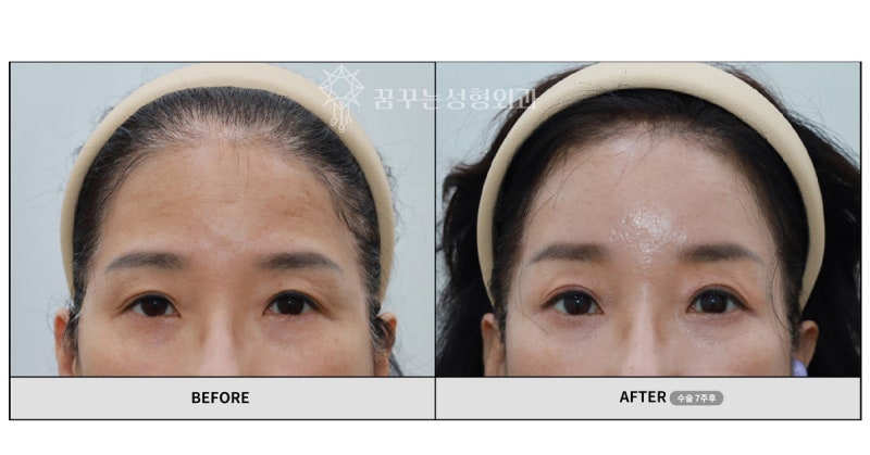 내시경이마거상, 받고 나서 후회하지 않으려면 살펴야 하는 것 사진 2