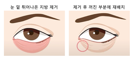 강남하안검수술 vs 눈밑지방재배치, 차이점 알고 계신가요? 사진 2
