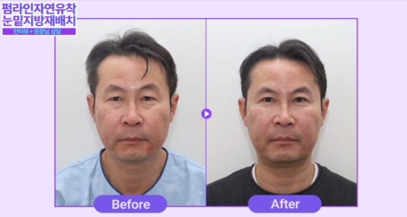 강남 남자눈성형, 자연스럽게 잘하는 병원을 찾고 계신다면