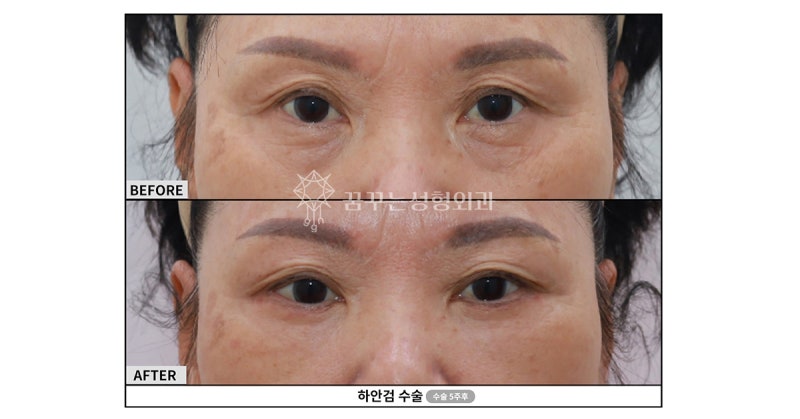 강남눈밑지? 다크서클 확실하게 없애는 핵심은 ‘이것’ 입니다. 사진 5
