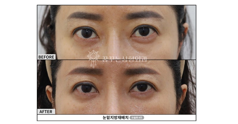 강남눈밑지? 다크서클 확실하게 없애는 핵심은 ‘이것’ 입니다. 사진 3
