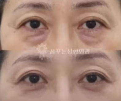 강남 하안검, 대표 원장이 가장 자주 듣는 질문 5가지 사진 11
