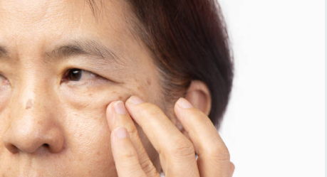 텐써마 시술로 눈가 주름 고민 해결하기 사진 9