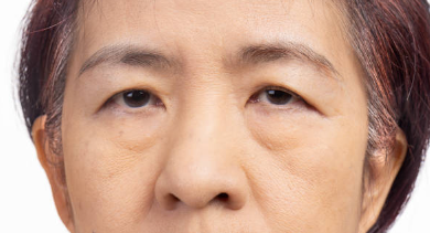 눈매교정 쌍꺼풀수술 안검하수 고민된다면 사진 6