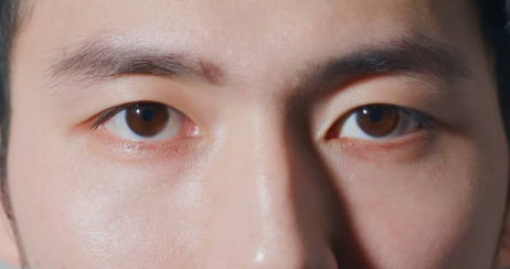 눈매교정 쌍꺼풀수술 안검하수 고민된다면 사진 9