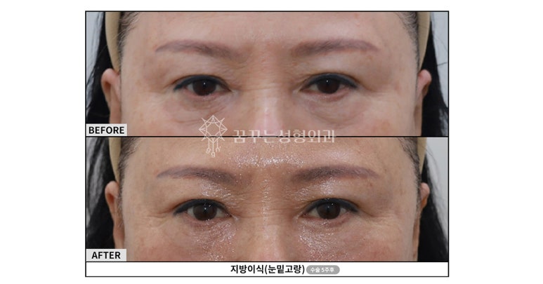 강남 눈밑지방재배치 어떤 경우에 필요한지부터 생각하자 사진 8