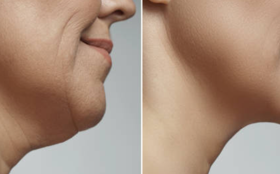 미니거상 시술이 갖고 있는 특징은 무엇일까? 사진 11