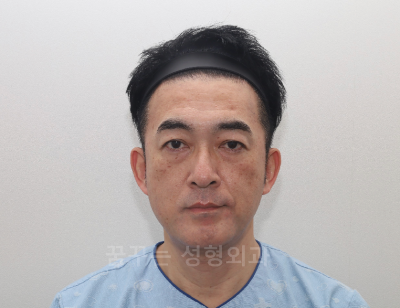🇰🇷 강남역 눈밑지방재배치 수술, 50대 일본인 남성의 리얼 후기 🇯🇵 사진 4
