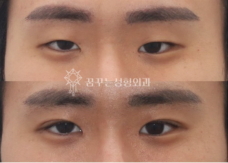 자연스러운 쌍꺼풀을 원한다면? 강남역 자연유착 쌍꺼풀 수술! 사진 9