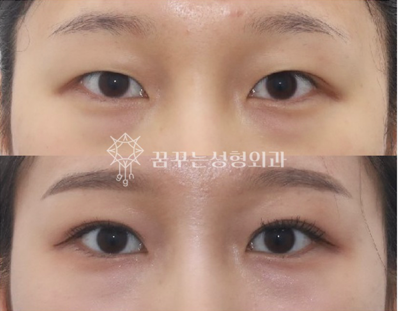 자연스러운 쌍꺼풀을 원한다면? 강남역 자연유착 쌍꺼풀 수술! 사진 6