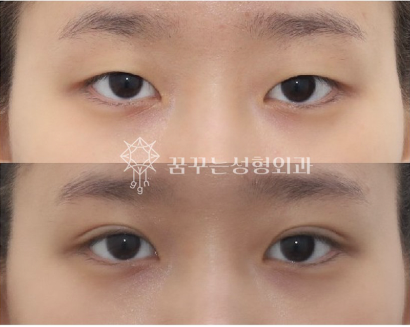 자연스러운 쌍꺼풀을 원한다면? 강남역 자연유착 쌍꺼풀 수술! 사진 5