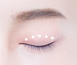 자연스러운 쌍꺼풀을 원한다면? 강남역 자연유착 쌍꺼풀 수술! 사진 2