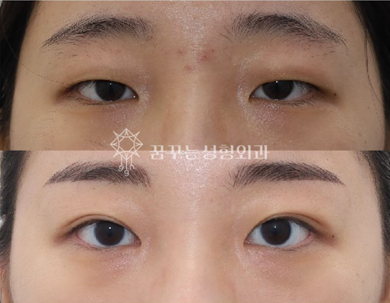 자연스러운 쌍꺼풀을 원한다면? 강남역 자연유착 쌍꺼풀 수술! 사진 7